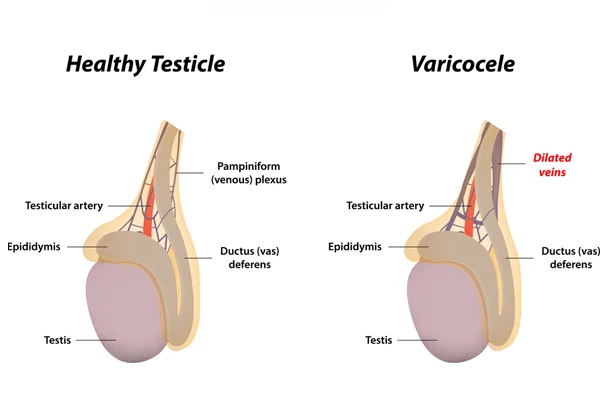 Varicocele