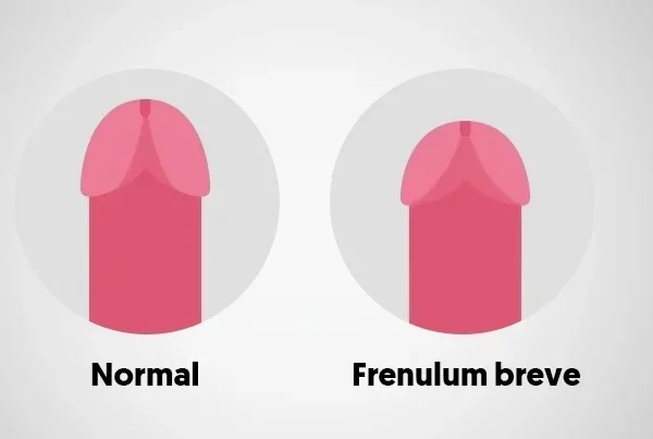 Tight Frenulum/Phimosis