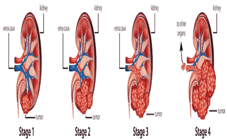 Kidney Cancer