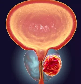 Prostate Cancer