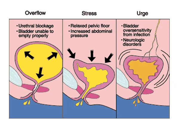 Incontinence