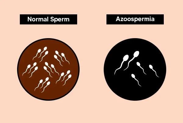 Azoospermia Nil spermsLow sperm counts