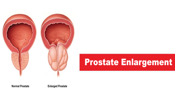 Prostate Enlargement