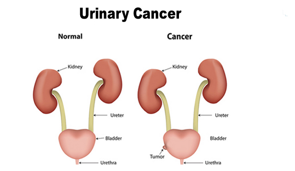 Urinary Cancers