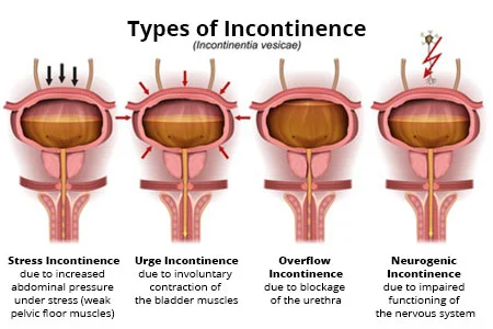 Incontinence